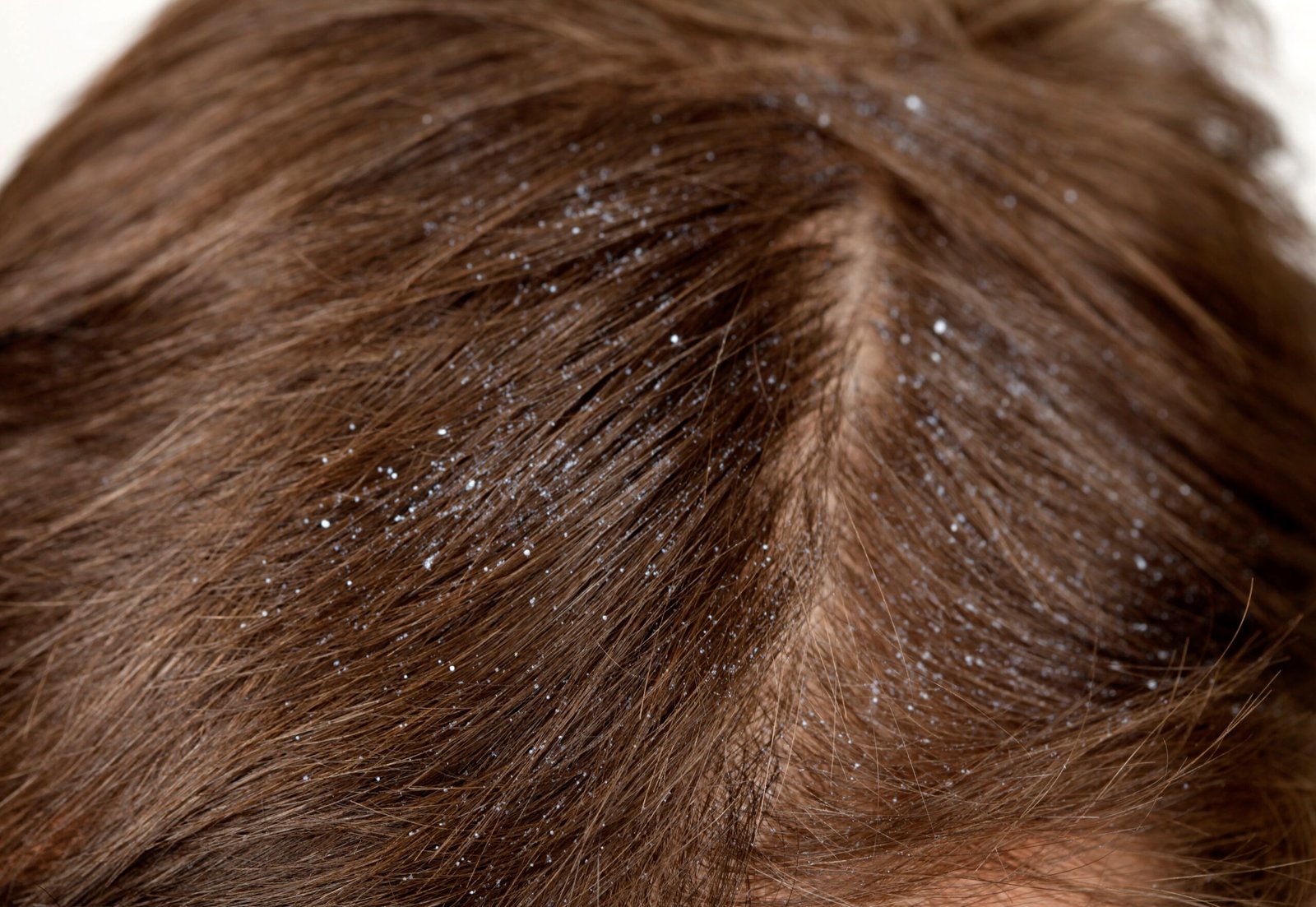 Measures to Prevent Dandruff